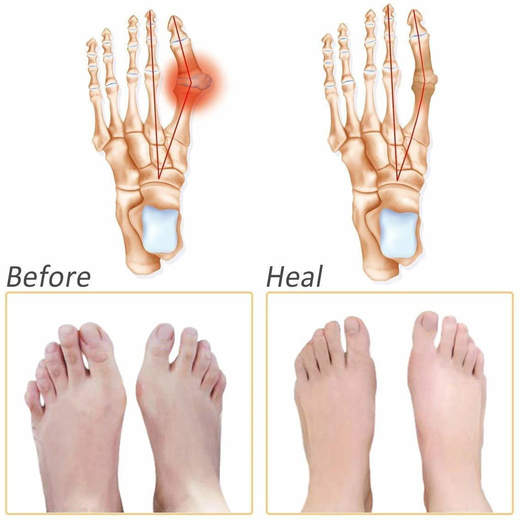 Silicone Half Toe Sleeve Heel Pads Tapkaw - Image 4