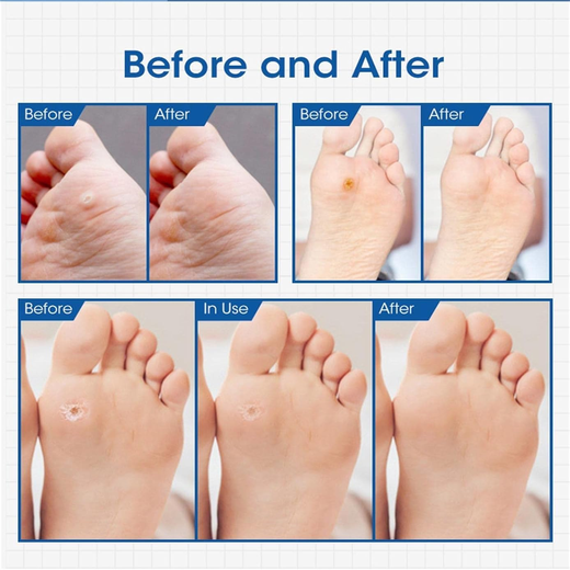 Foot Corn Remover (Pack of 8) - Image 3